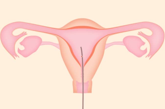 宫腔镜检查要花多少钱？