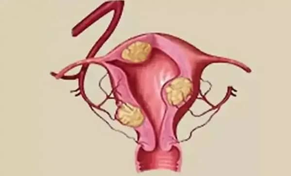 多囊卵巢综合症能治好吗？听听我的经验