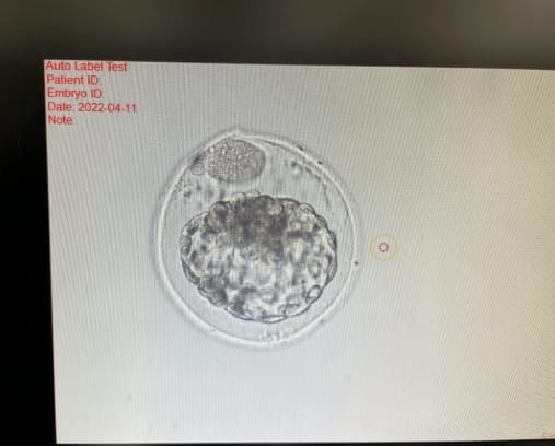 多囊卵巢怎么吃比较好
