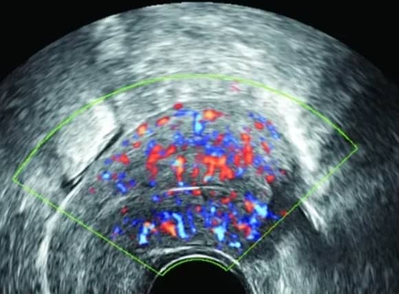 疤痕子宫做试管，成功率到底怎么样？