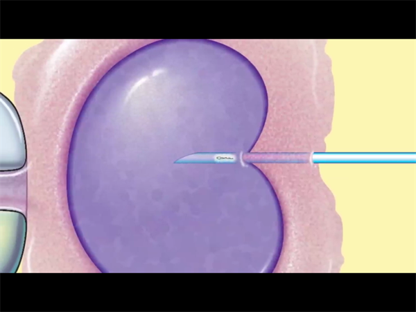 单身也能圆父母梦！这些国家允许未婚人士做试管婴儿